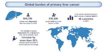 global burden of primary liver cancer - webnews featured image